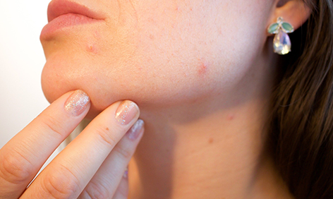 Laser Acne Treatment